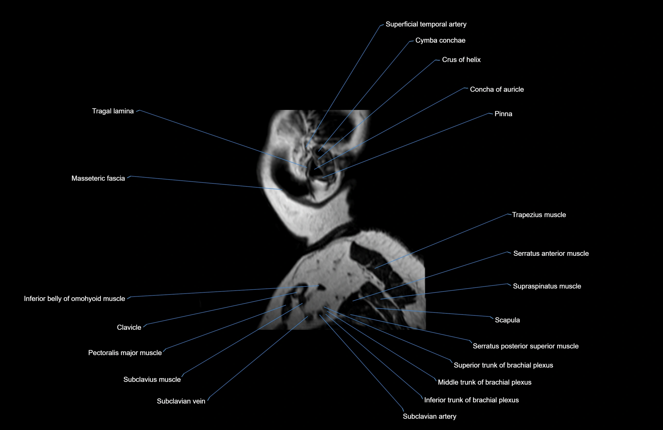 Neck MRI sagittal cross sectional anatomy 3D 1mm 3T radiology  image-img-00001-00042.webp